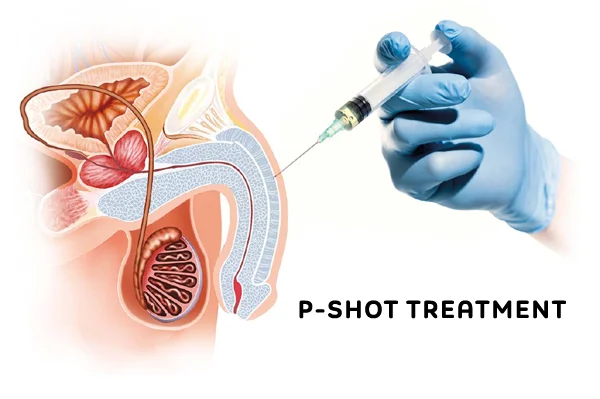 P Shot Treatment